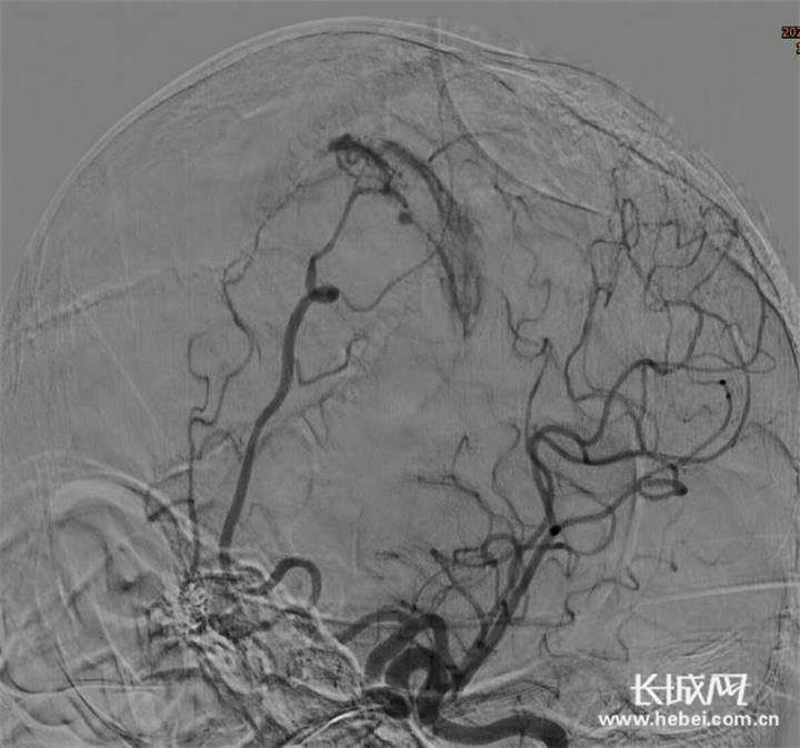术前脑血管造影