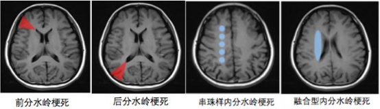 大暑时节别缺水 专家提示预防低灌性脑梗死